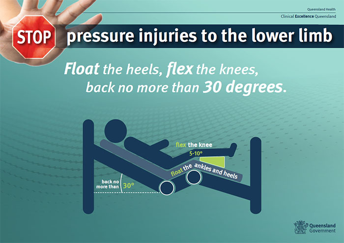 Pressure injuries to the lower limb: Float the heels, flex the knees back no more than 30 degrees