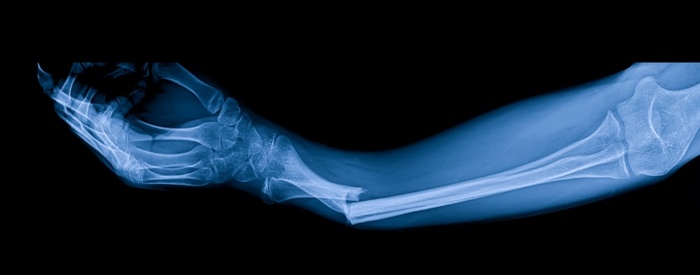 Orthopaedic Limb Injury